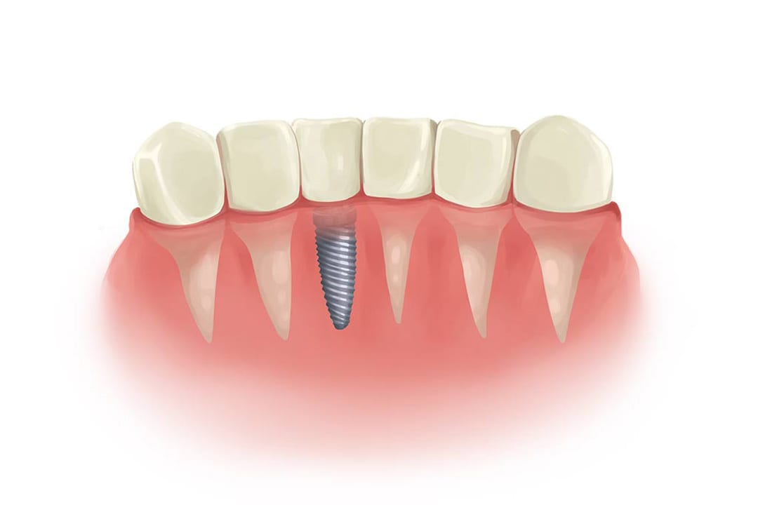 single dental implant