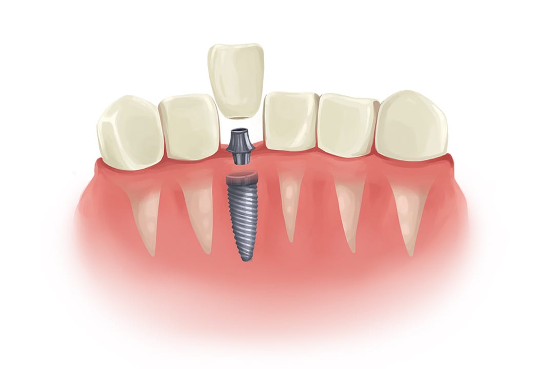 single-dental-implant dental implant prosthesis placement