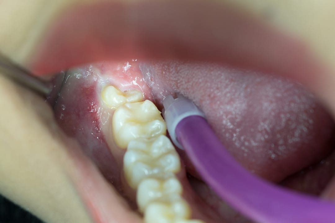 swollen and bleeding gums due to impacted wisdom tooth