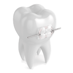 Ceramic braces in singapore | Transparent braces