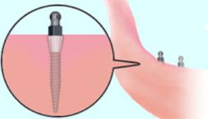 mini-dental-implant-ball mini dental ball implants - close up of a mini dental implant