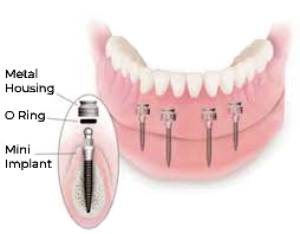 mini dental implant parts mini dental implants explained