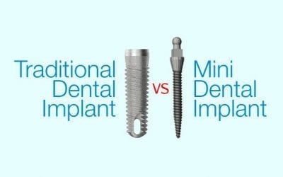 Traditional Dental Implants vs Mini Dental Implants