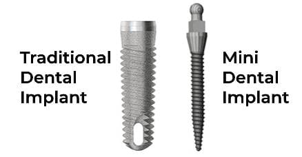 Mini dental implants vs traditional dental implants Mini dental implants vs traditional dental implants