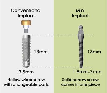 traditional implant size vs mini implant size