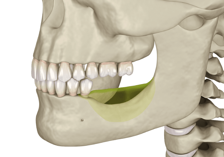 jaw bone loss
