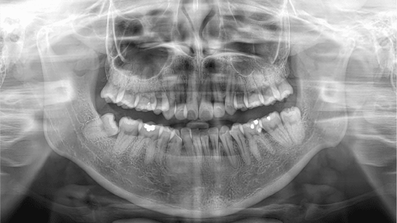Zenyum (6) Dental xrays and 3d intraoral scanning in singapore