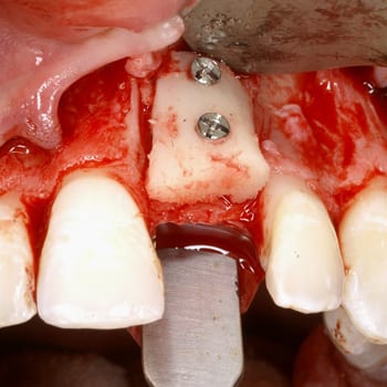 block-bone-grafting-in-singapore block bone grafting in Singapore | block bone grafts