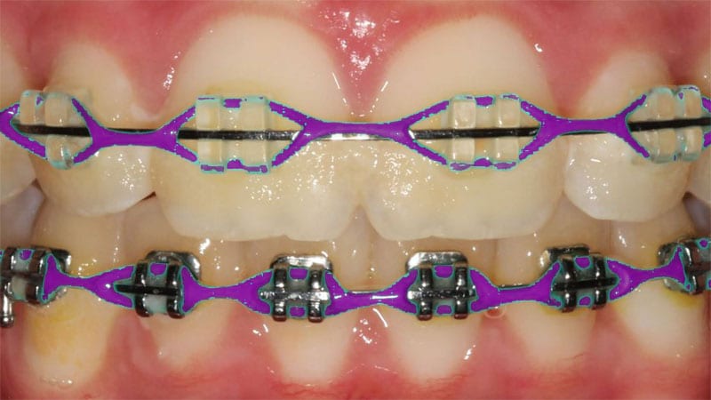 Braces Colours Personalised Braces Treatment Braces In Singapore Dark Purple Braces
