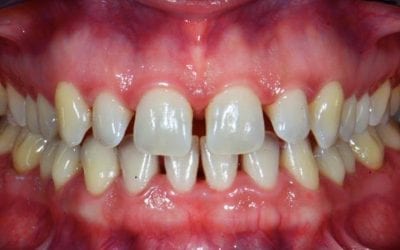 Diastema Causes and Treatment Options