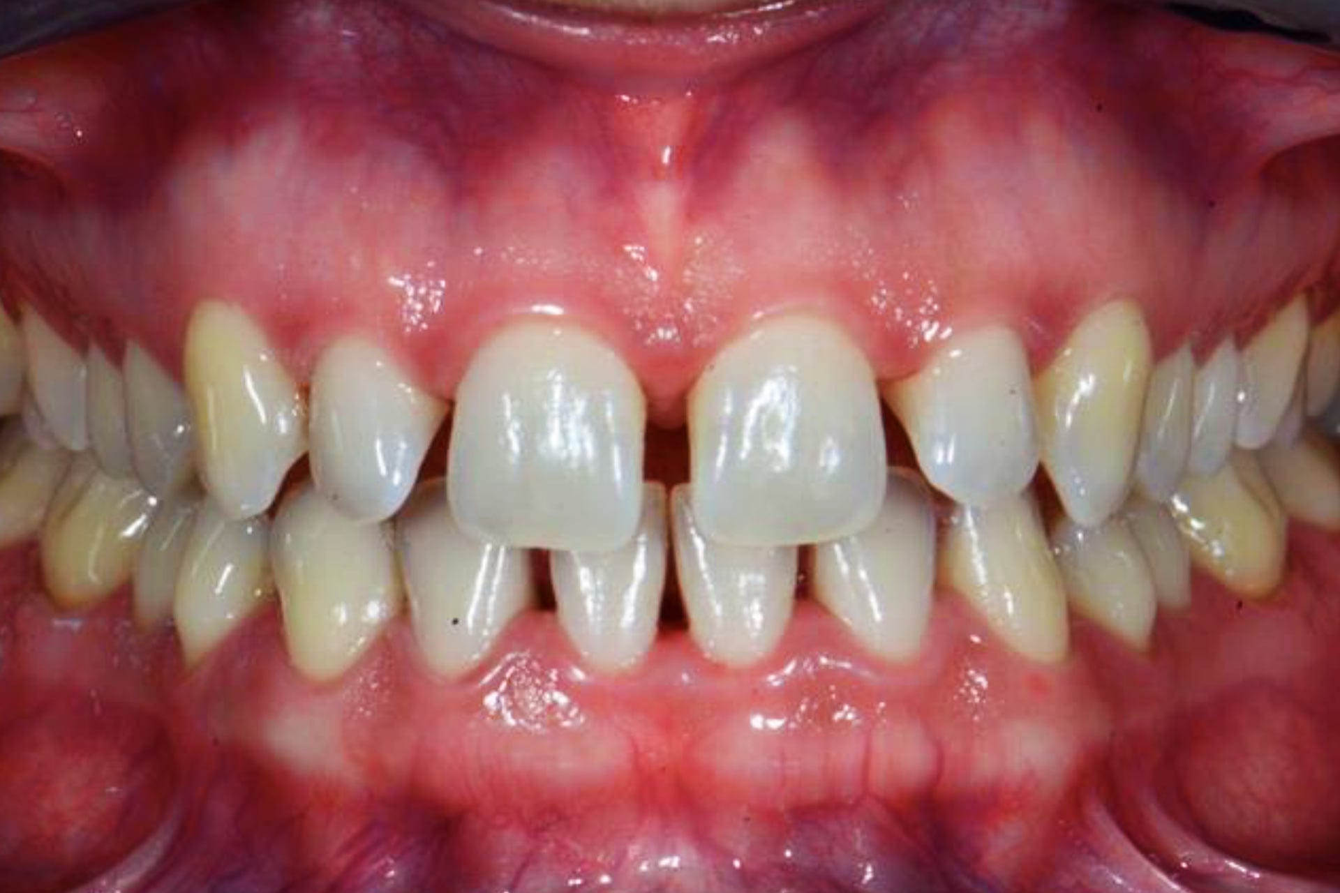 How to Fill Gaps Between Teeth: Your Guide to Diastema