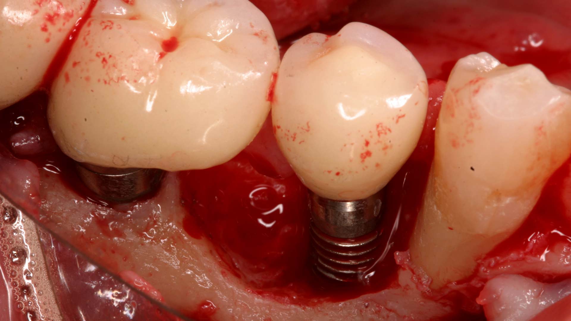 failed-dental-implant failed dental implant