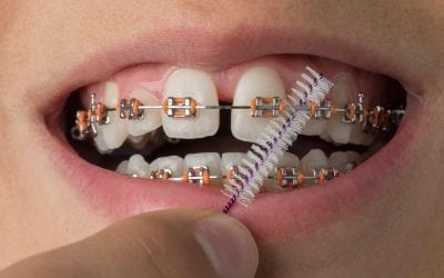 Best Ways to Keep Your Teeth Clean & Healthy While Wearing Braces