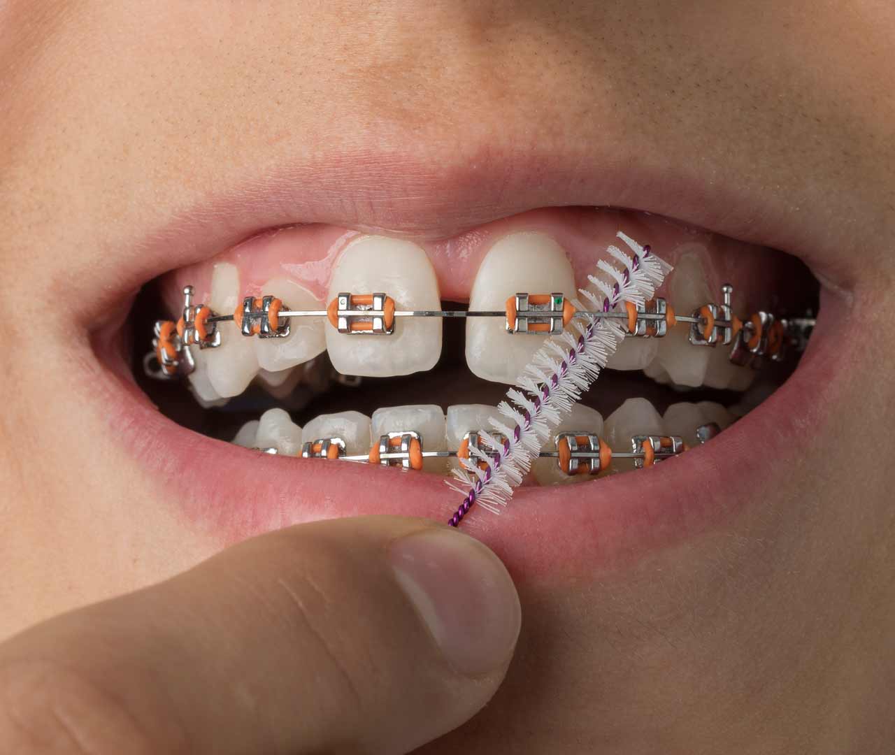 Braces brush store