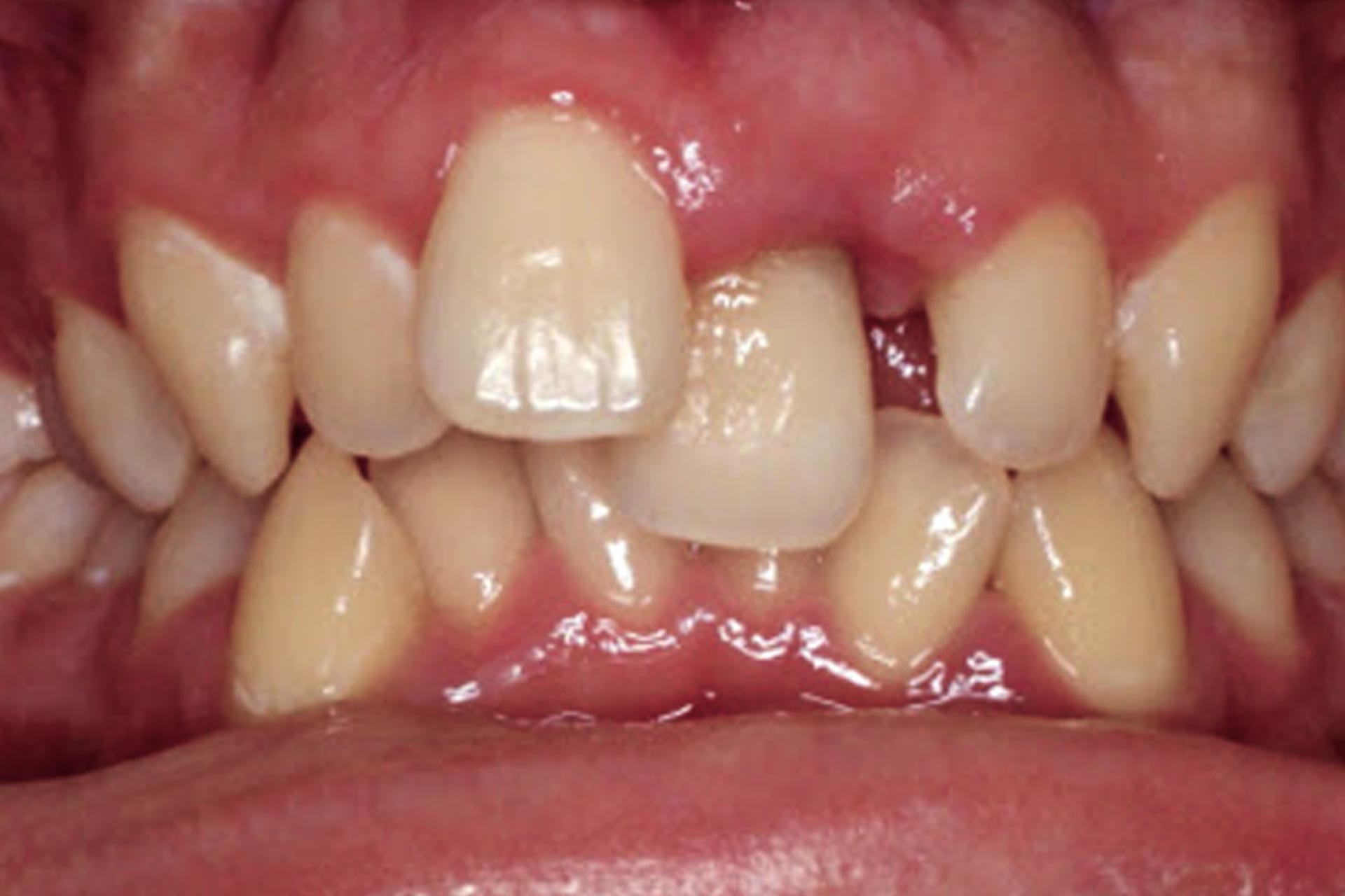 mismatched teeth size