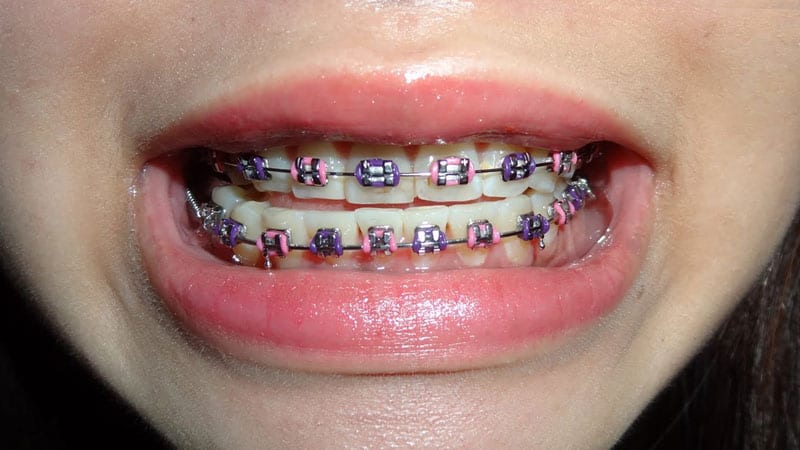 multi-coloured braces combinations