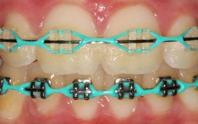 Choosing the Right Colour of Braces