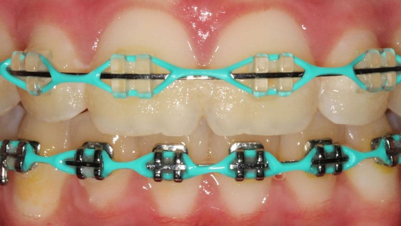 Slim Neon Blue Clip-On Braces