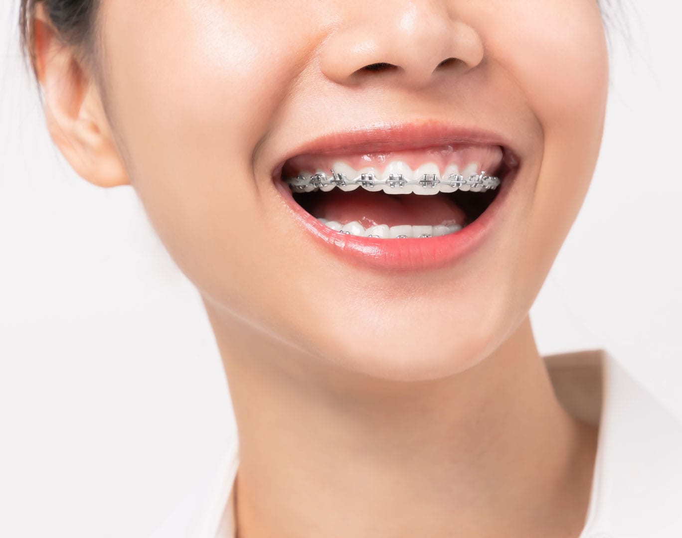 selecting the right braces colour