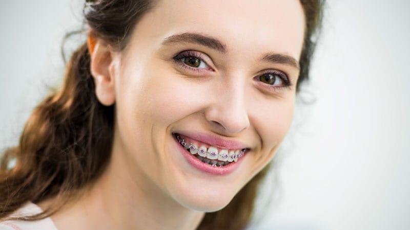 braces for adults in singapore