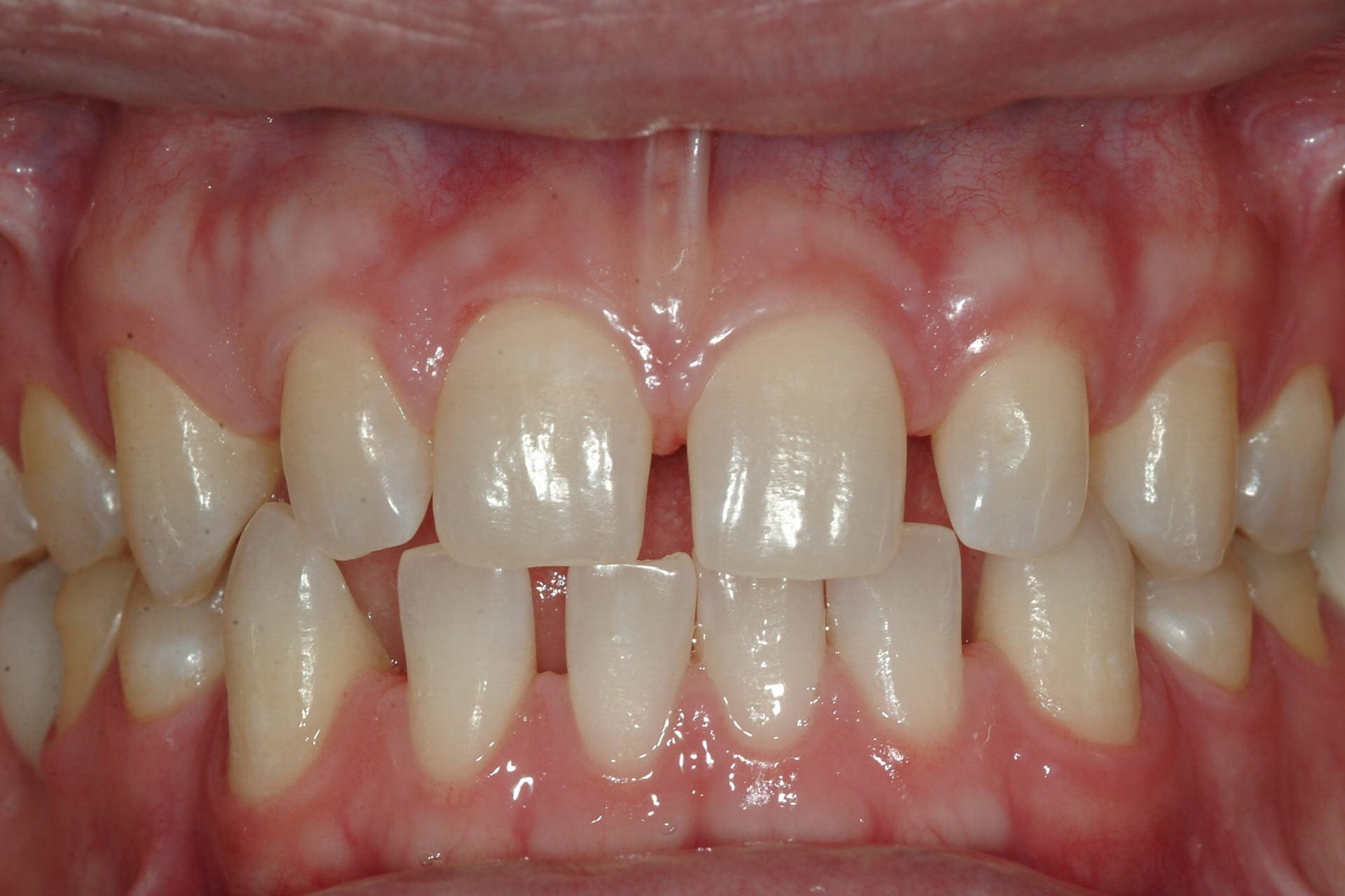 spacing-between-teeth spacing between teeth