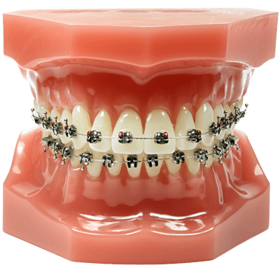 metal braces in singapore