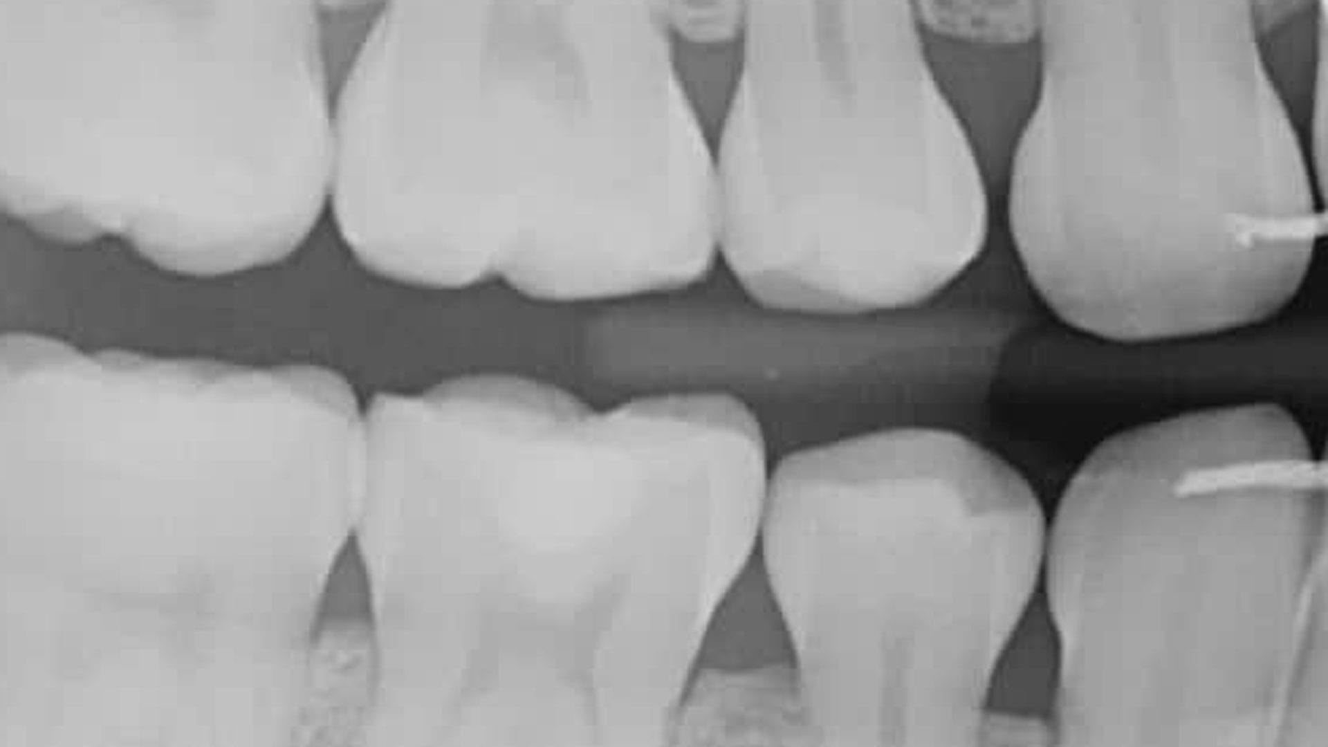 Bitewing Xray