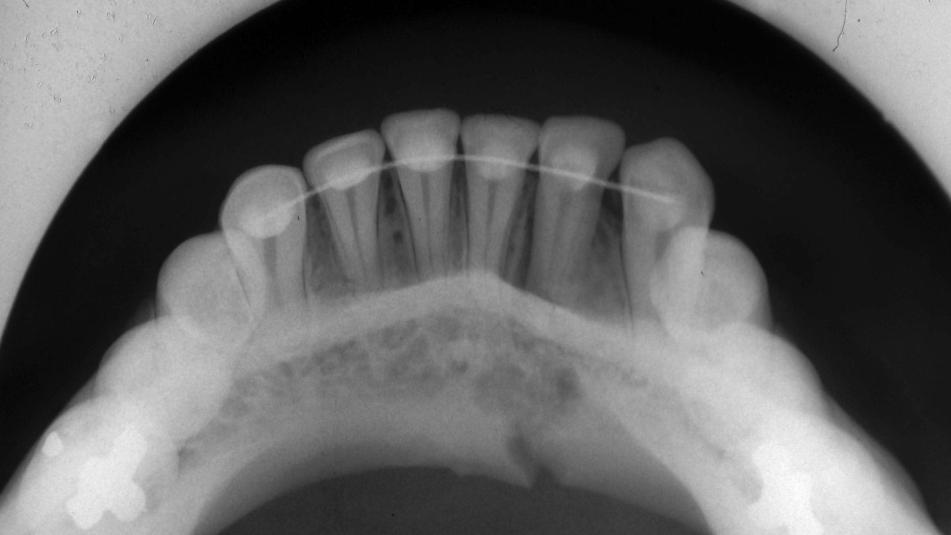occlusal X Ray