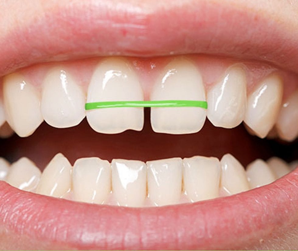 The Dangers of DIY Braces - NoFrills Dental