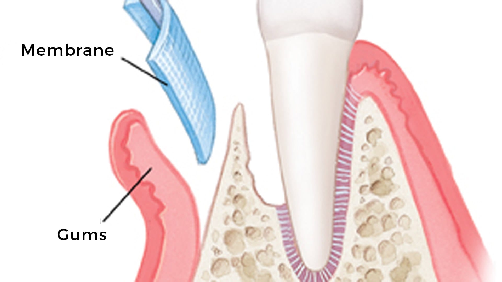 guided tissue regeneration gum surgery