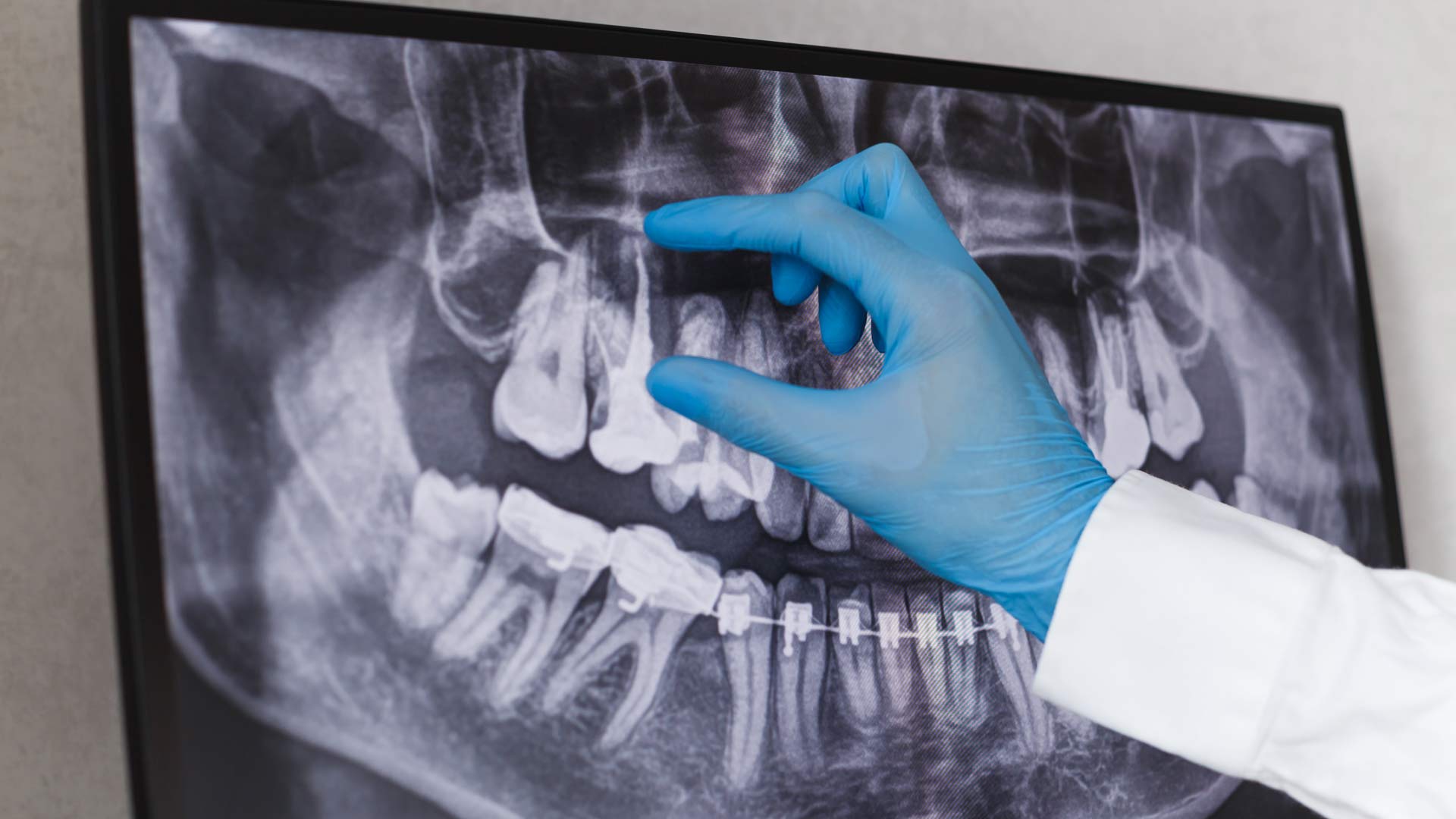 xray imaging before root canal treatment