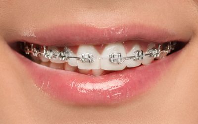 When Do I Need Braces?