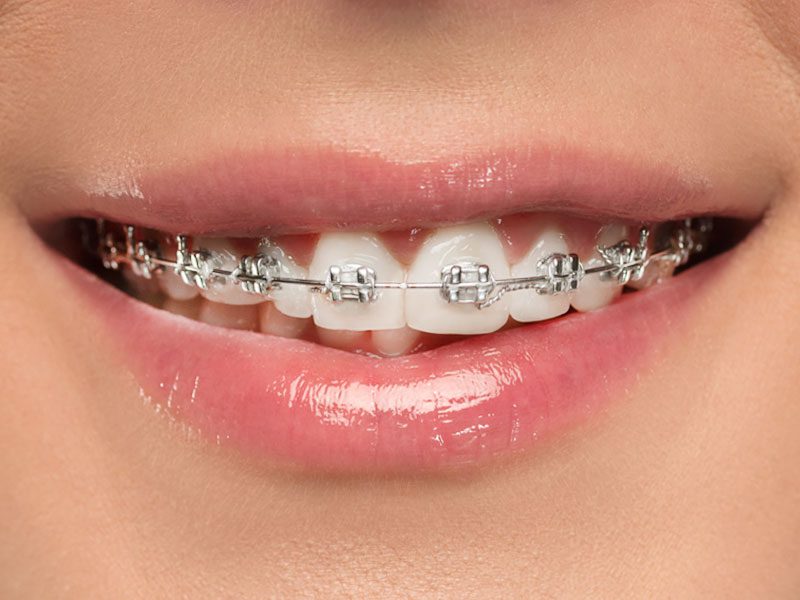 Close up of orthodontic braces