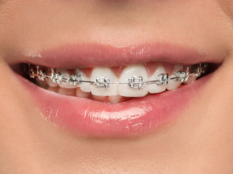 When Do I Need Braces? - NoFrills Dental