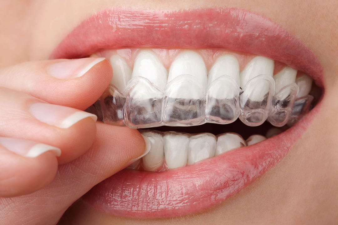 removing Invisalign clear aligners