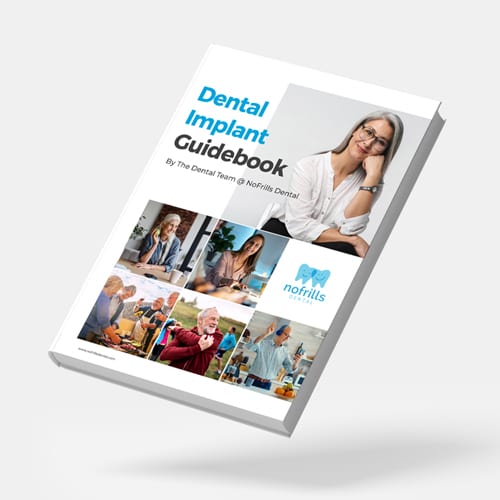 Dental Implants Guide