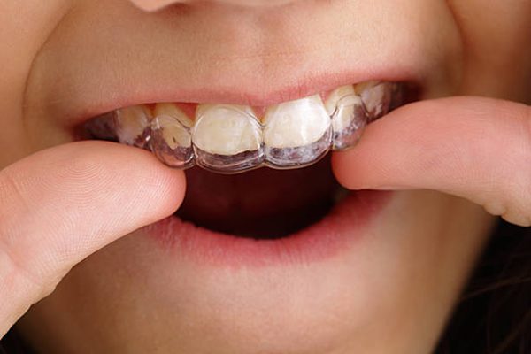 wearing Invisalign clear aligners