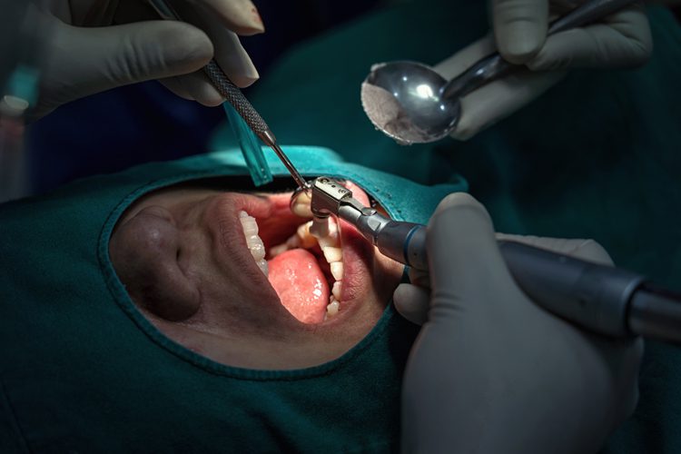 close up of root canal treatment