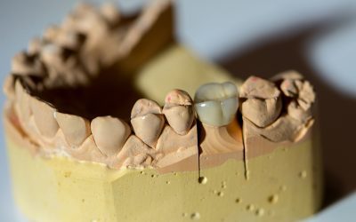 What Problems Could Develop with a Dental Crown?