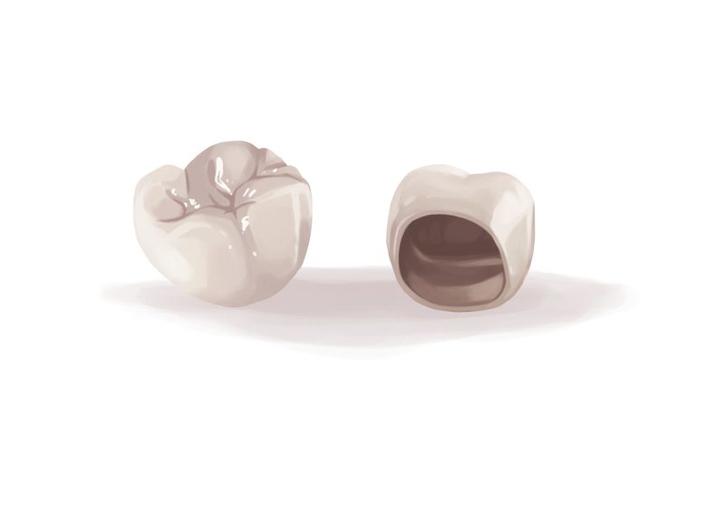 loose dental implant loose dental implant