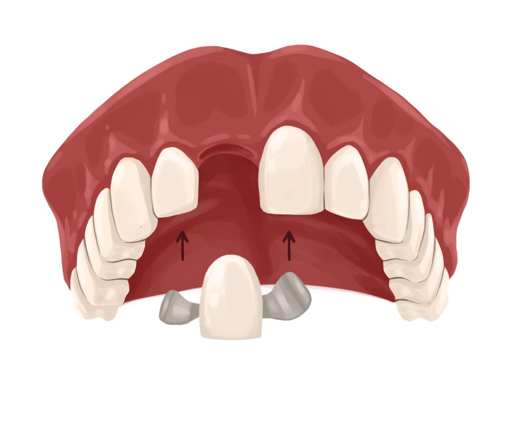 Adhesive Maryland Dental Bridge Cartoon