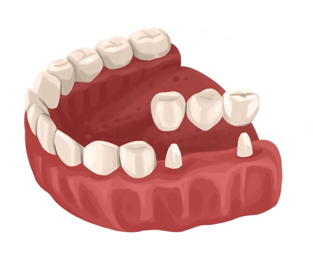 Conventional Dental Bridge Cartoon Image