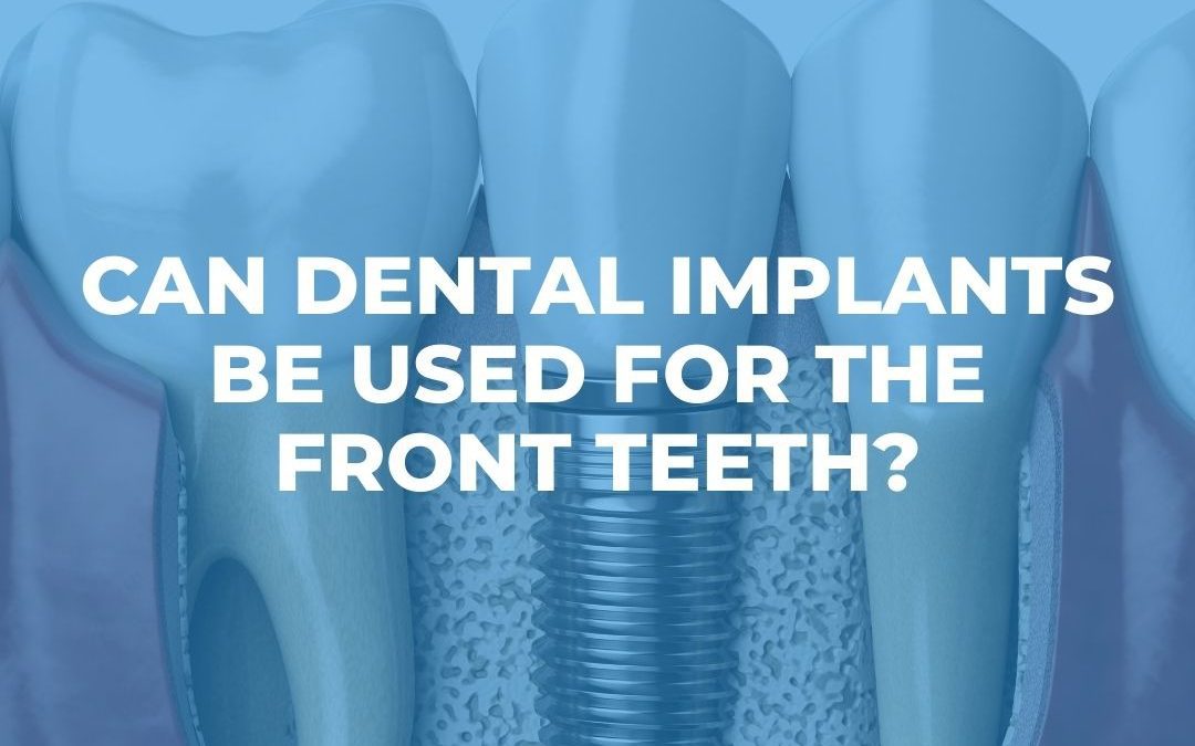 dental implant featured image