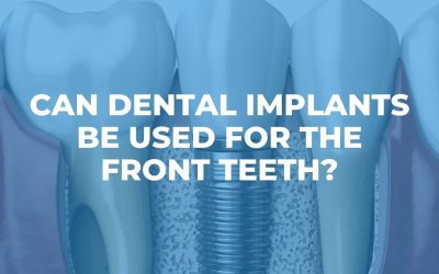 Can Dental Implants be Used for the Front Teeth?