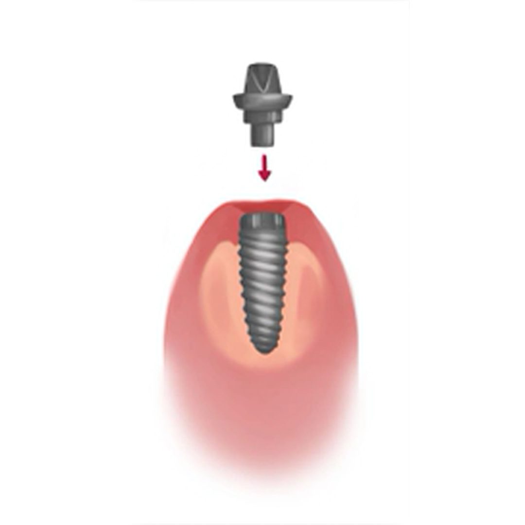 Dental Implanting Stage 3