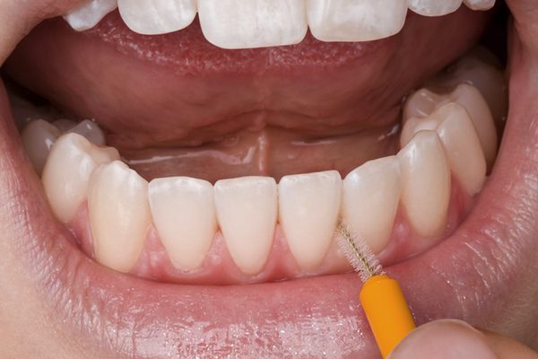 Interdental tooth brushing