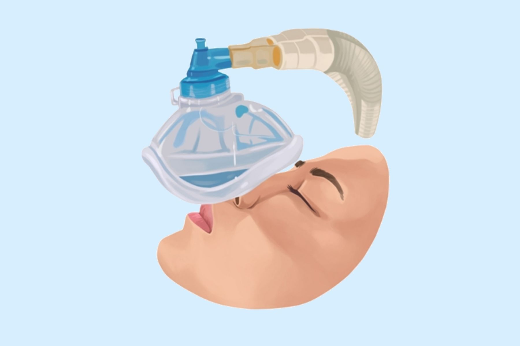 General Anesthetic General Anesthetic