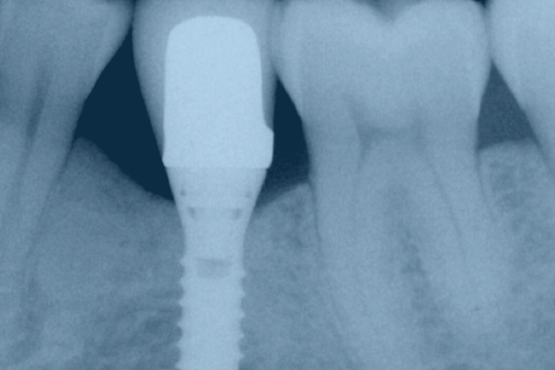 Peri-Implantitis Peri-Implantitis