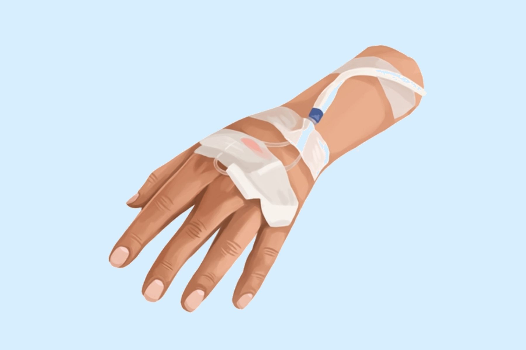 Intravenous Sedation with Local Anesthesia Intravenous Sedation with Local Anesthesia