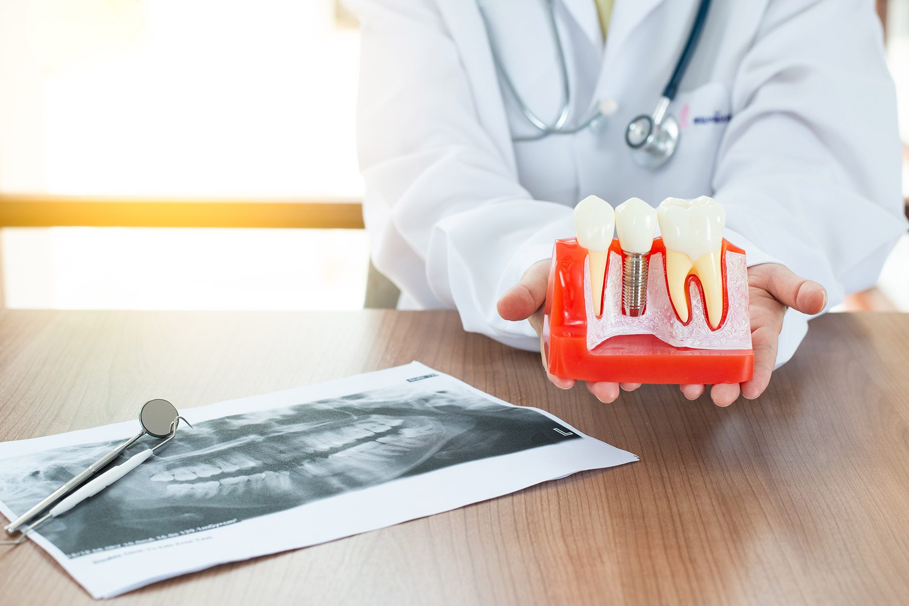 dentist with dental implant model dentist with dental implant model